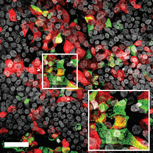 Picture bronchioalveolar-like culture