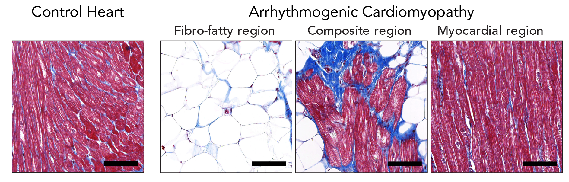 Image of a normal heart and a heart of a patient with arrhythmogenic cardiomyopathy