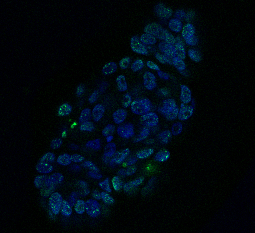 Afbeelding van tumor-organoïde van hoofd-halskanker, behandeld met cisplatine.