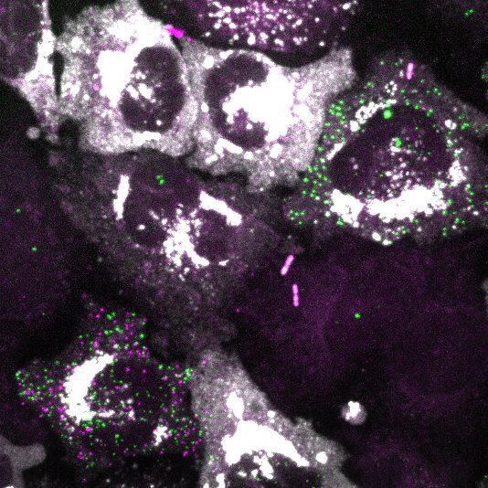 Image of cells showing the infection by a virus and the antiviral response.